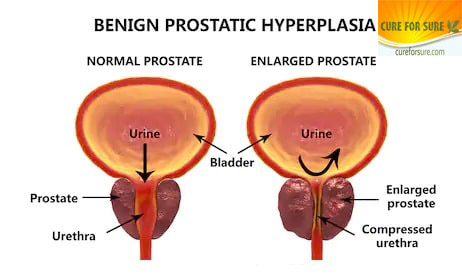 Prostate/  पौरुष ग्रंथी/ अष्ठीला ग्रंथी 